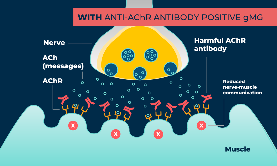 With gMG, harmful AChR antibodies may stop muscles from getting some messages sent by nerves, leading to reduced muscle movement.